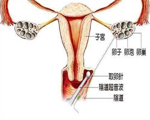 输卵管结扎不孕